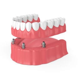  implant secured dental restorations