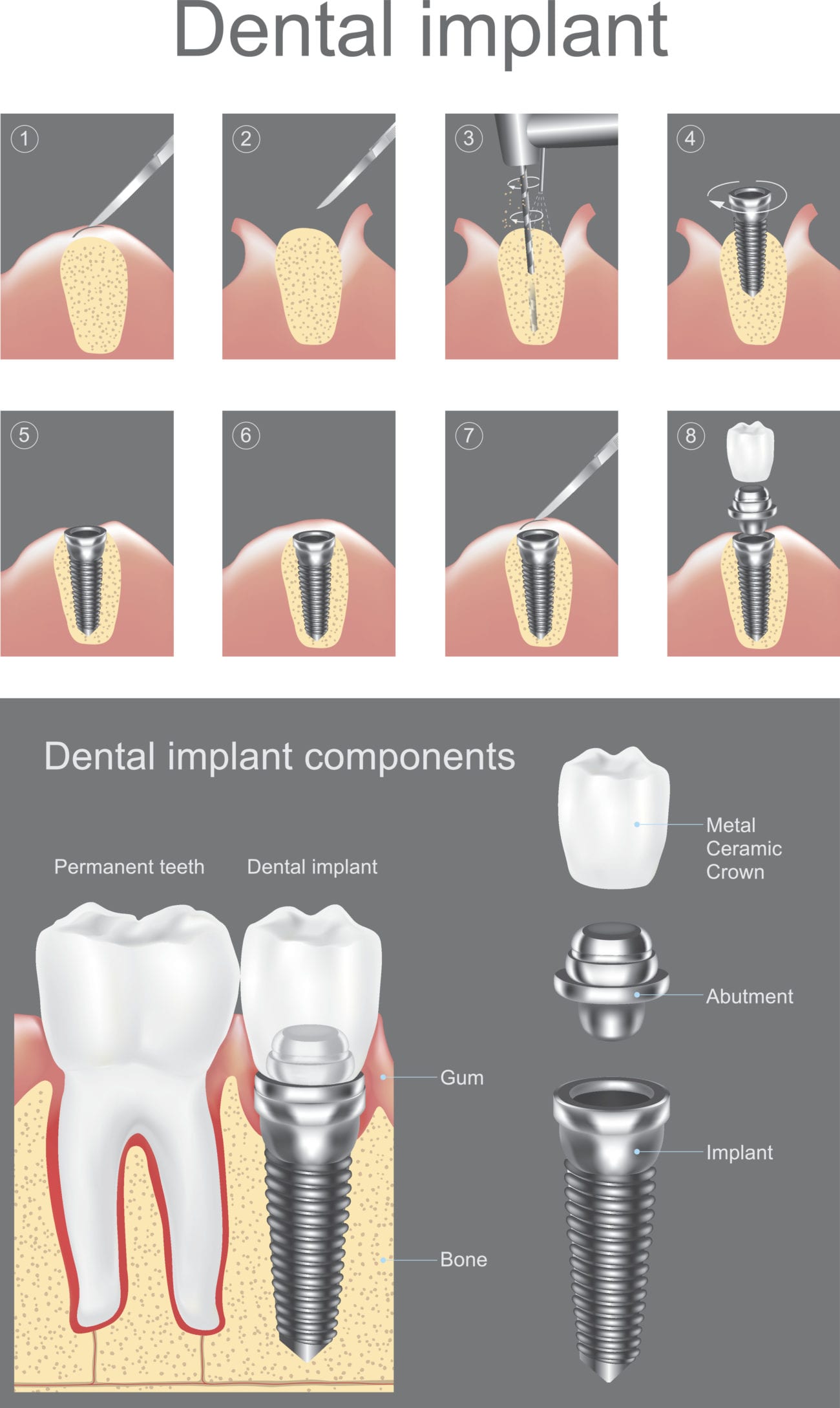 The Denture Timeline: A Practical Guide For Busy People - ACCDIS ...